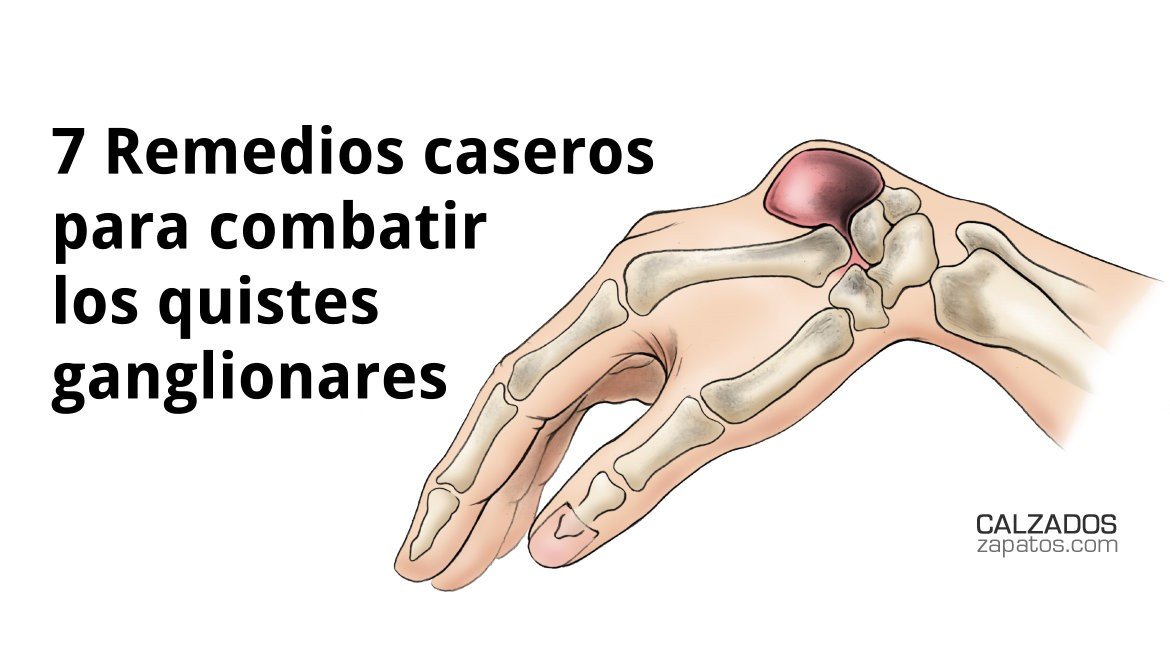7 Remedios caseros para combatir los quistes ganglionares
